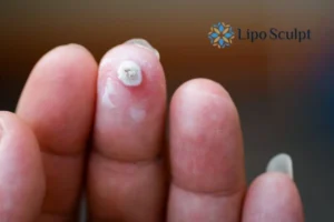 Cryopen Top 5 Treatable Conditions 4 Do you have a persistent wart of verruca that you cannot shit? Cryopen Hampton in Arden treatment will work call us NOW!