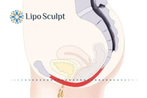 Pelvic Floor Chair Therapy 1 Pelvic Floor Chair Therapy Hampton in Arden to treat incontinence.