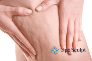 CoolSculpting for Legs: The Innovative Approach to Redefining Your Legs 5 Start your journey today book your coolsculpting treatment Hampton in Arden online today!