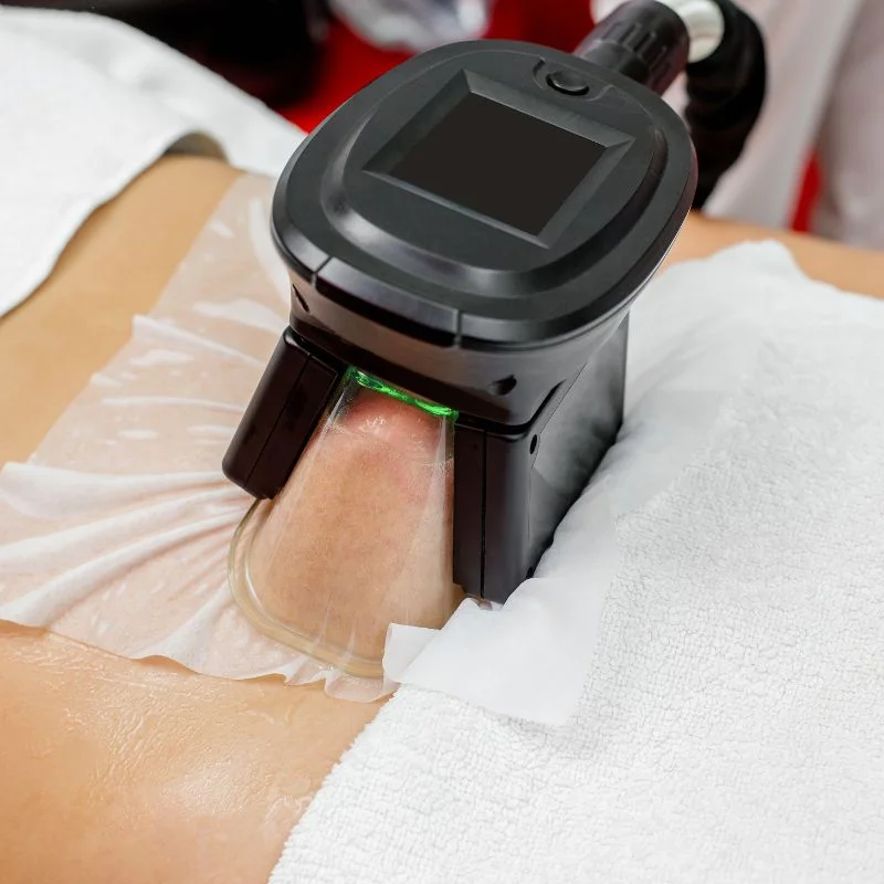 Fat Freezing treatment Hampton in Arden